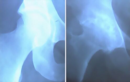 Столовые ложки артроза коленного сустава